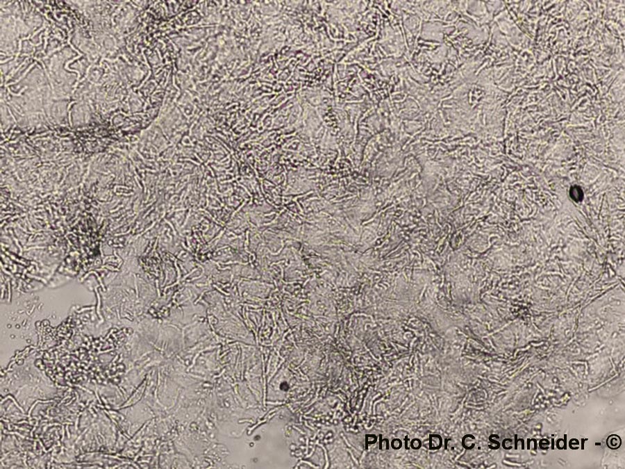 Pityriasis versicolor